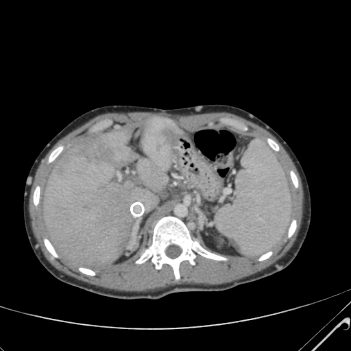 File:Nutmeg liver- Budd-Chiari syndrome (Radiopaedia 46234-50635 B 18).png