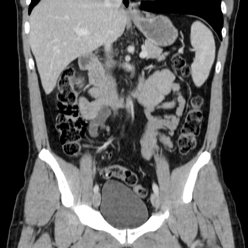 File:Obstructing ureteric calculus (Radiopaedia 18615-18514 C 36).jpg