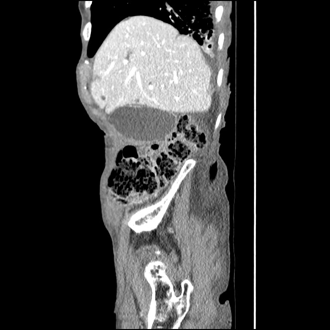 Obturator hernia causing small bowel obstruction (Radiopaedia 65522-74612 C 81).jpg