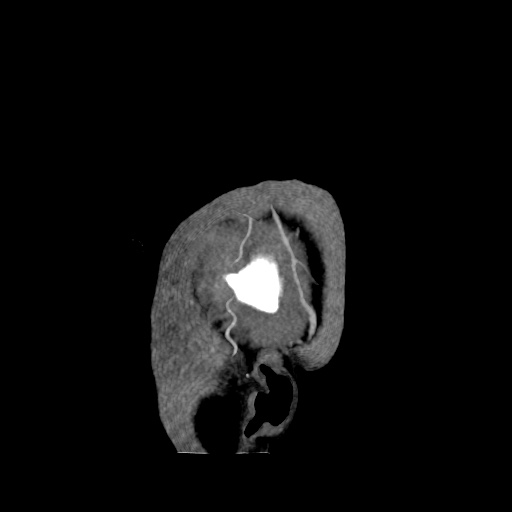 Occipital extradural hematoma simulating venous sinus thrombosis (Radiopaedia 46514-50964 D 2).jpg
