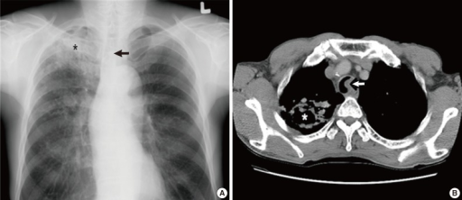 a)Image reveals tuberculosis asterisk b) CT scan of the chest shows tuberculosis with cavitation asterisk