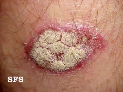 File:Psoriasis (Dermatology Atlas 6).jpg