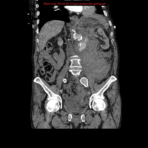 File:Abdominal aortic aneurysm- extremely large, ruptured (Radiopaedia 19882-19921 Coronal C+ arterial phase 56).jpg