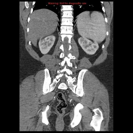 Abdominal aortic aneurysm (Radiopaedia 8190-9038 Coronal C+ arterial phase 97).jpg