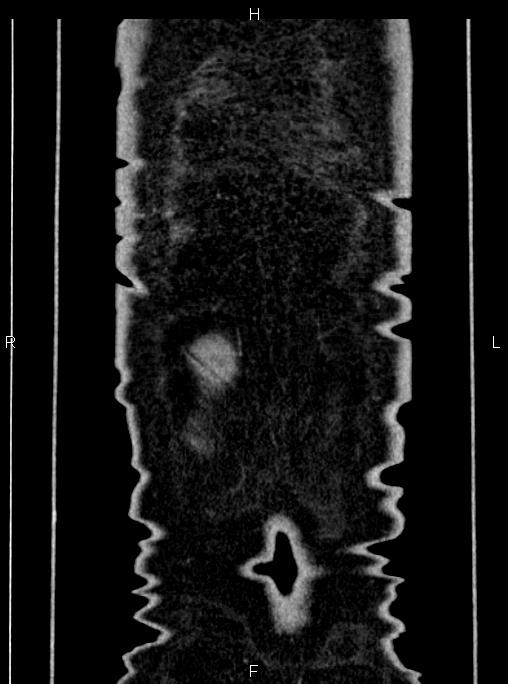 Abdominal aortic aneurysm (Radiopaedia 83094-97462 Coronal renal cortical phase 93).jpg