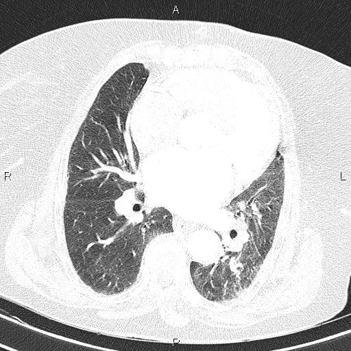 Abdominal aortic aneurysm (Radiopaedia 85063-100606 Axial lung window 38).jpg
