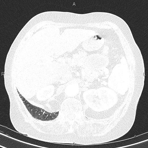 Abdominal aortic aneurysm (Radiopaedia 85063-100606 Axial lung window 63).jpg