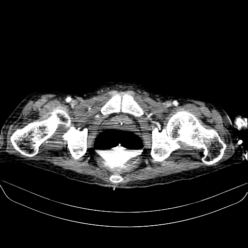 File:Abdominal collection due to previous cecal perforation (Radiopaedia 80831-94320 Axial C+ portal venous phase 207).jpg