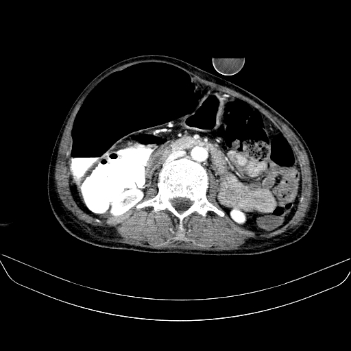 File:Abdominal collection due to previous cecal perforation (Radiopaedia 80831-94320 Axial C+ portal venous phase 98).jpg
