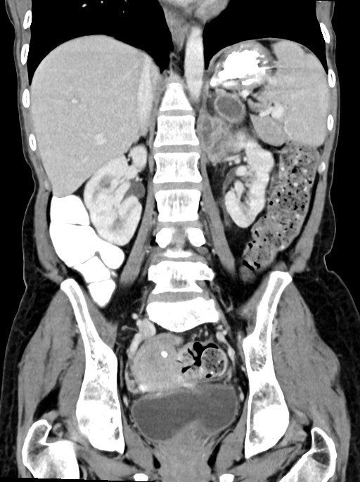 Abdominal wall and retroperitoneal tuberculosis (Radiopaedia 88137-104729 Coronal C+ portal venous phase 62).jpg