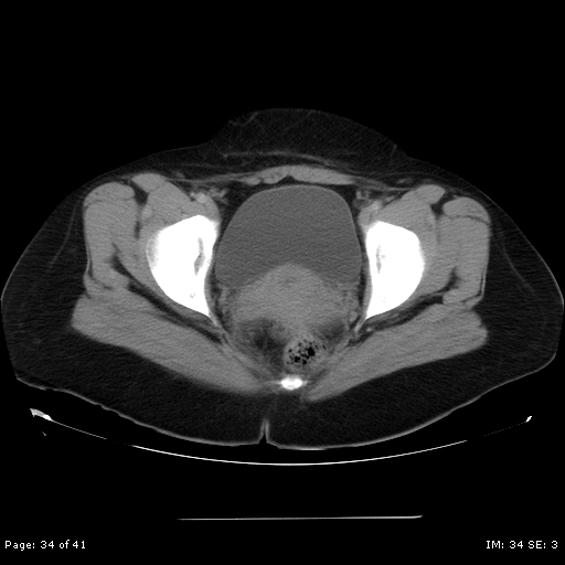 File:Abdominal wall endometriosis (Radiopaedia 25723-25885 Axial C+ portal venous phase 34).jpg