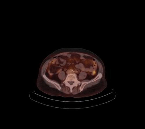 File:Abdominal wall metastasis from colorectal carcinoma (Radiopaedia 31016-31719 C 49).jpg