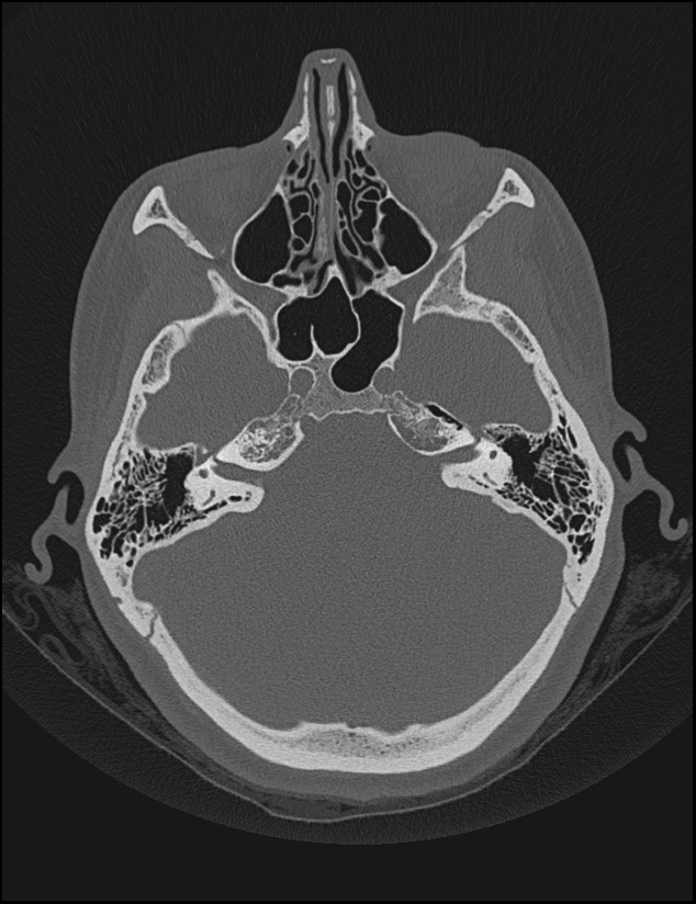 Aberrant right internal carotid artery (Radiopaedia 65191-74198 Axial non-contrast 49).jpg