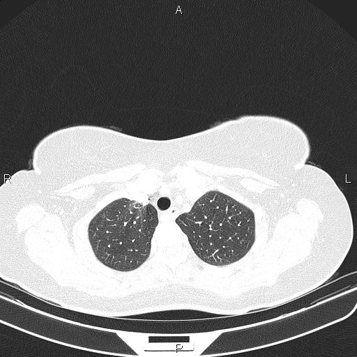 Aberrant right subclavian artery (Radiopaedia 87334-103629 Axial lung window 16).jpg