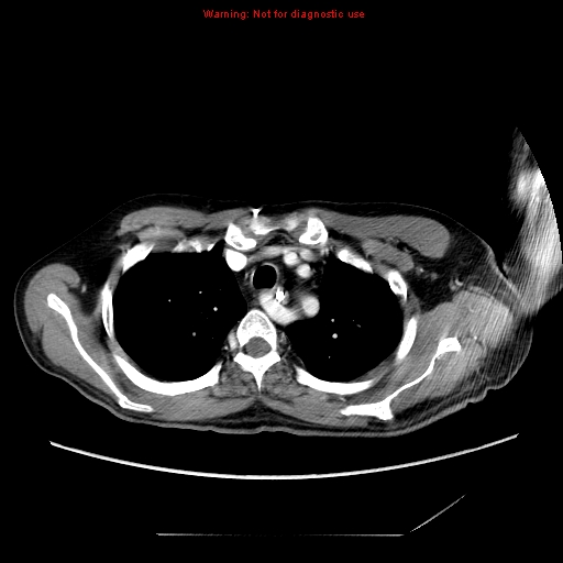 File:Aberrant right subclavian artery (Radiopaedia 9379-10071 Axial C+ arterial phase 16).jpg