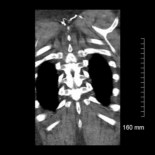 Aberrant right subclavian artery stenosis (Radiopaedia 52656-58670 B 75).jpg