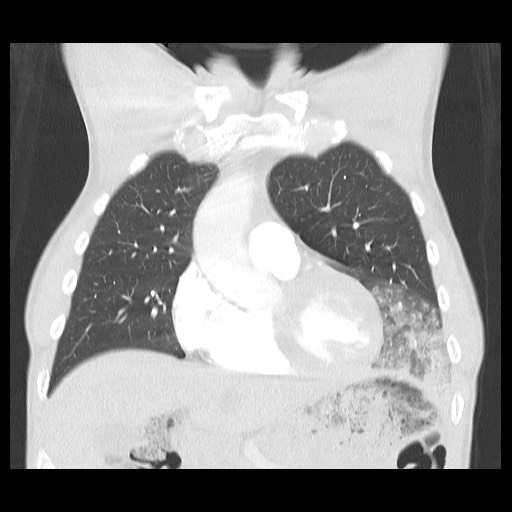 File:Accessory left horizontal fissure with lingular pneumonia (Radiopaedia 53763-59843 Coronal lung window 15).jpg