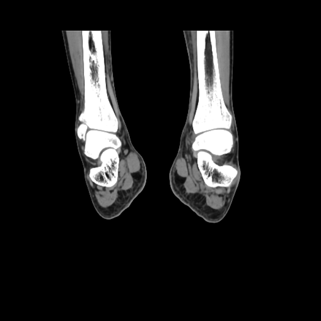 Accessory soleus muscle (Radiopaedia 61069-68943 Coronal non-contrast 47).jpg