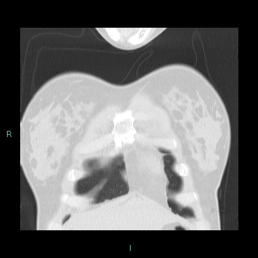 Accidental foreign body aspiration (seamstress needle) (Radiopaedia 77740-89983 Coronal lung window 59).jpg