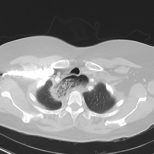 File:Achalasia (Radiopaedia 47147-51685 Axial lung window 8).png