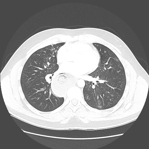 Achalasia (Radiopaedia 52507-58417 Axial lung window 36).jpg