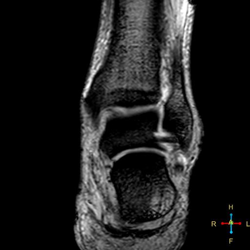 File:Achilles tendon complete tear (Radiopaedia 22834-22854 T2 fat sat 9).jpg