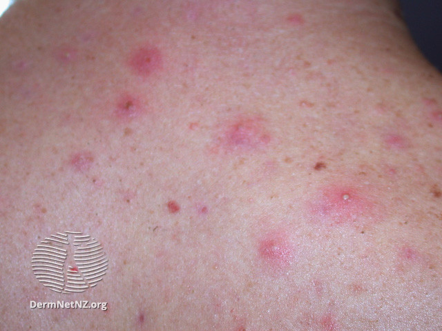 File:Acne affecting the back images (DermNet NZ acne-acne-back-179).jpg