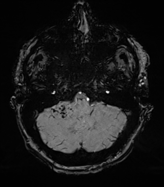 Acoustic schwannoma (Radiopaedia 50846-56358 Axial SWI 18).png