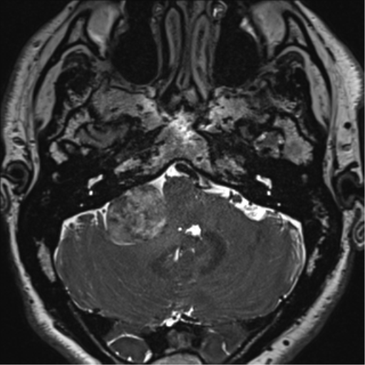 File:Acoustic schwannoma (Radiopaedia 50846-56358 Axial T2 16).png