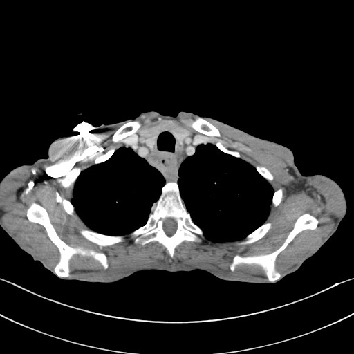 File:Acquired tracheoesophageal fistula (Radiopaedia 57747-65042 Axial C+ portal venous phase 14).jpg