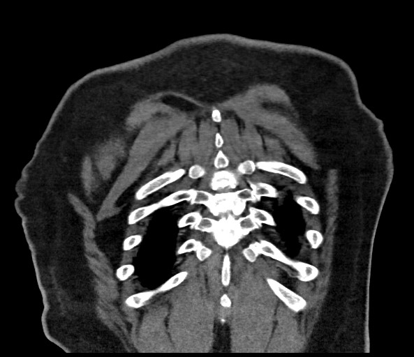 Acromioclavicular joint cyst (Radiopaedia 58455-65610 Coronal C+ arterial phase 127).jpg