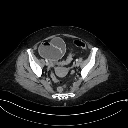 Active Crohn disease (Radiopaedia 59394-66750 Axial C+ portal venous phase 60).jpg