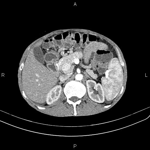 Active crohn disease (Radiopaedia 87133-103397 Axial C+ arterial phase 35).jpg
