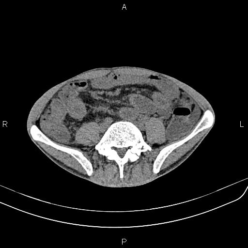 Active crohn disease (Radiopaedia 87133-103397 Axial non-contrast 67).jpg