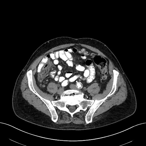 File:Active lower gastrointestinal bleeding - diverticular (Radiopaedia 61203-69106 Axial C+ arterial phase 27).jpg