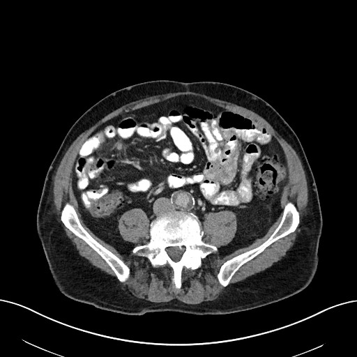 File:Active lower gastrointestinal bleeding - diverticular (Radiopaedia 61203-69106 Axial C+ portal venous phase 79).jpg