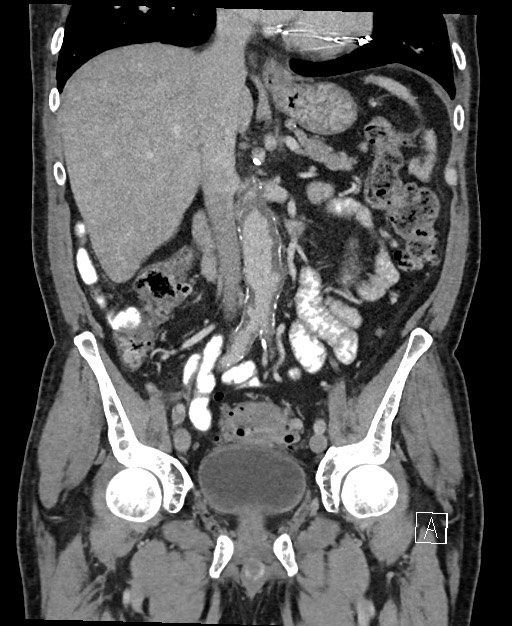 Active lower gastrointestinal bleeding - diverticular (Radiopaedia 61203-69106 Coronal C+ portal venous phase 69).jpg
