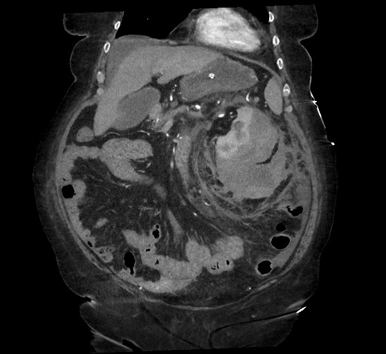 Active renal extravasation with large subcapsular and retroperitoneal hemorrhage (Radiopaedia 60975-68796 Coronal C+ arterial phase 55).jpg