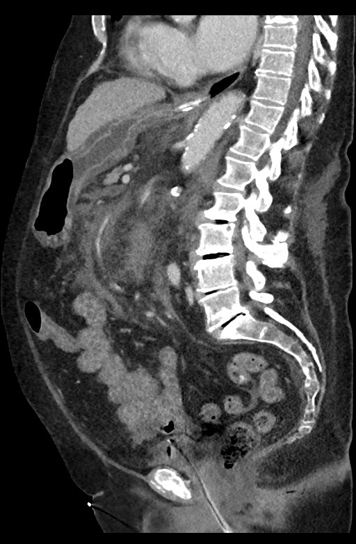 Active renal extravasation with large subcapsular and retroperitoneal hemorrhage (Radiopaedia 60975-68796 Sagittal C+ portal venous phase 116).jpg