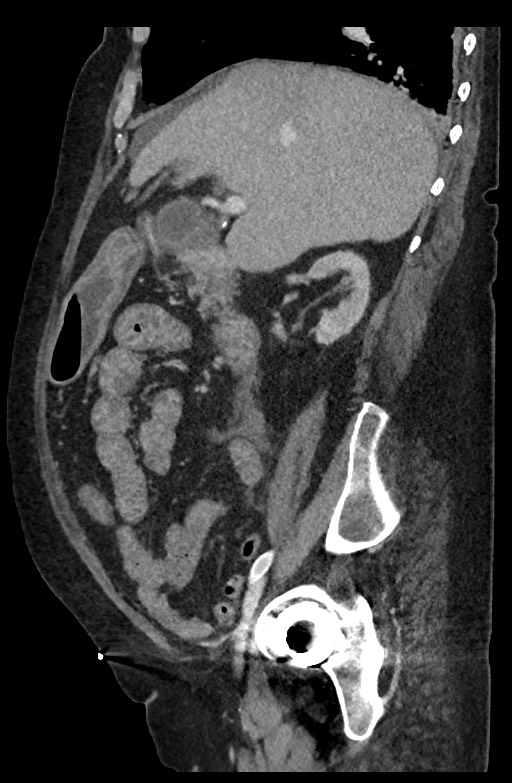 Active renal extravasation with large subcapsular and retroperitoneal hemorrhage (Radiopaedia 60975-68796 Sagittal C+ portal venous phase 147).jpg