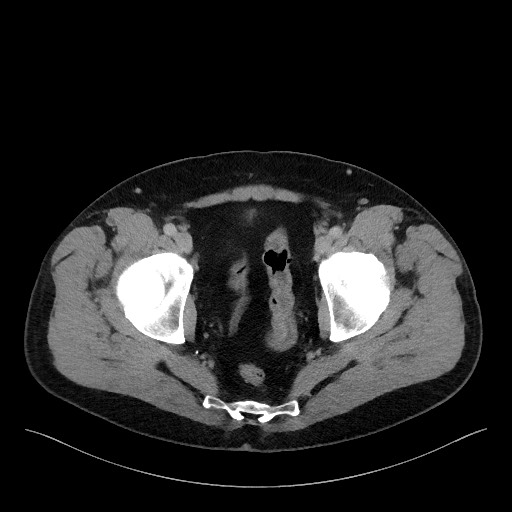 File:Acute-on-chronic pancreatitis (Radiopaedia 67286-76656 Axial C+ portal venous phase 75).jpg