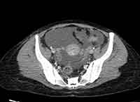Acute Budd-Chiari syndrome (Radiopaedia 60858-68638 A 245).jpg