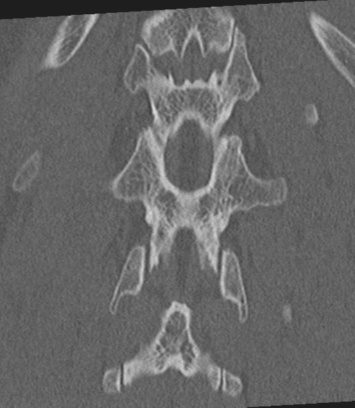 Acute L1 burst compression fracture (Radiopaedia 34430-35755 Coronal bone window 46).png