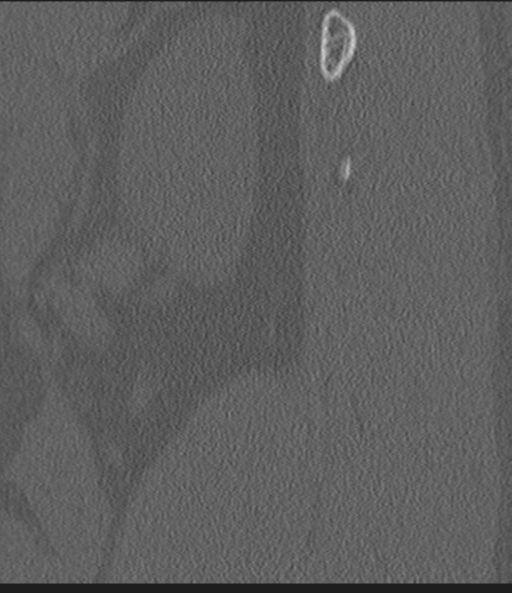 Acute L1 burst compression fracture (Radiopaedia 34430-35755 Sagittal bone window 4).png