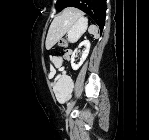 File:Acute appendicitis, heterotaxy syndrome (Radiopaedia 66884-76202 Sagittal C+ portal venous phase 50).jpg