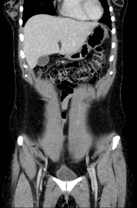 Acute appendicitis (Radiopaedia 22892-22918 Coronal C+ portal venous phase 10).png