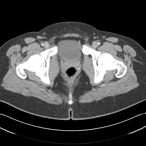 Acute appendicitis (Radiopaedia 30297-30934 Axial C+ portal venous phase 80).jpg