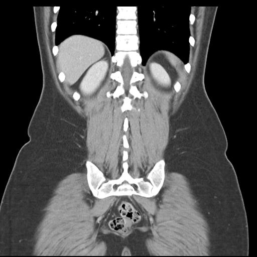 Acute appendicitis (Radiopaedia 30297-30934 Coronal C+ portal venous phase 38).jpg