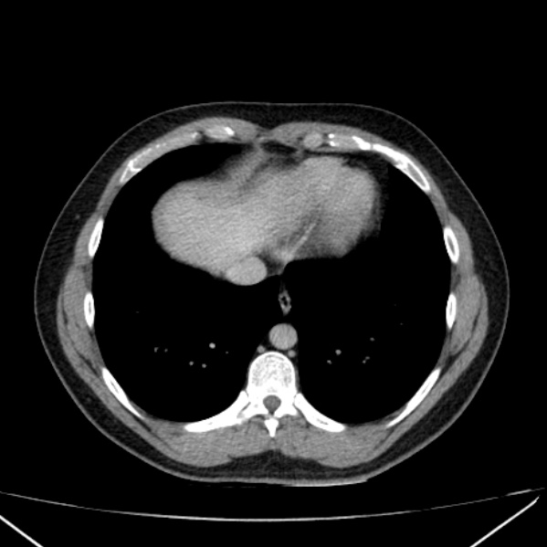 File:Acute appendicitis (Radiopaedia 38255-40270 Axial C+ portal venous phase 4).jpg