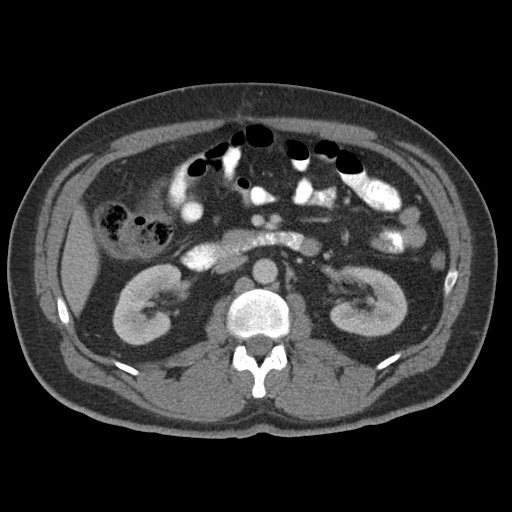 Acute appendicitis (Radiopaedia 48511-53463 Axial C+ portal venous phase 43).jpg